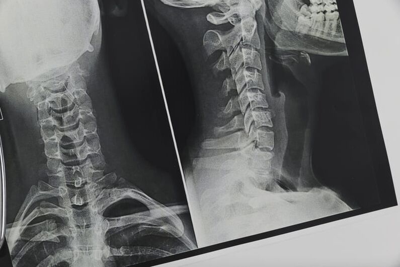 Osteokondrosiak eragindako zerbikal-bizkarrezurreko X izpiak