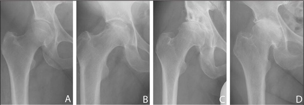 Hip artikulazioko artrosiaren garapenaren faseak X izpietan