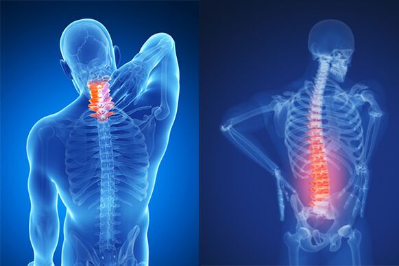 Trápaga eta lumbar bizkarrezurra osteokondrosia