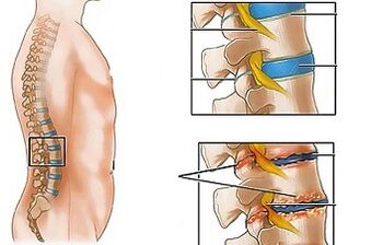 Lumbararen osteokondrosiaren kausak