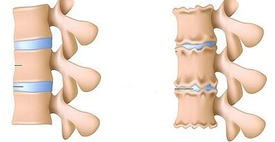 Nola aitortu lumbararen osteokondrosiaren presentzia